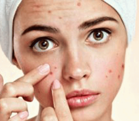5 Điều Nên Tránh Khi Chăm Sóc Da Nhờn Và Mụn Chăm sóc da nhờn và mụn