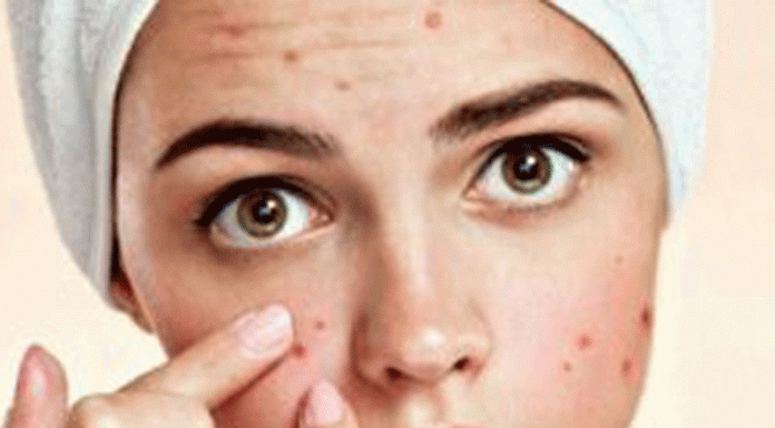 5 Điều Nên Tránh Khi Chăm Sóc Da Nhờn Và Mụn Chăm sóc da nhờn và mụn