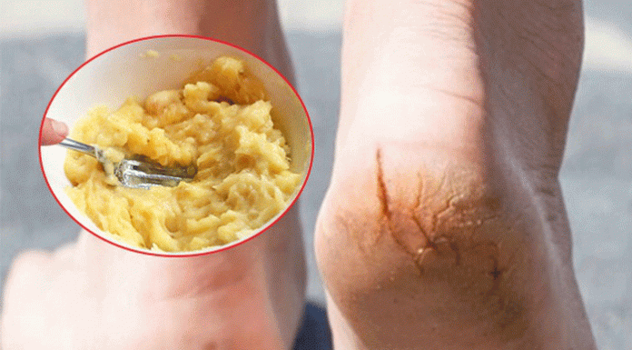 Lộ bàn chân sần sùi khi mang giày hở gót, áp dụng ngay cách trị nứt nẻ gót chân này Cách trị nứt nẻ gót chân